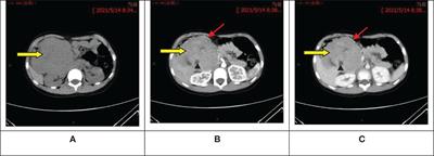 Ewing sarcoma of the pancreas: a pediatric case report and <mark class="highlighted">narrative literature review</mark>